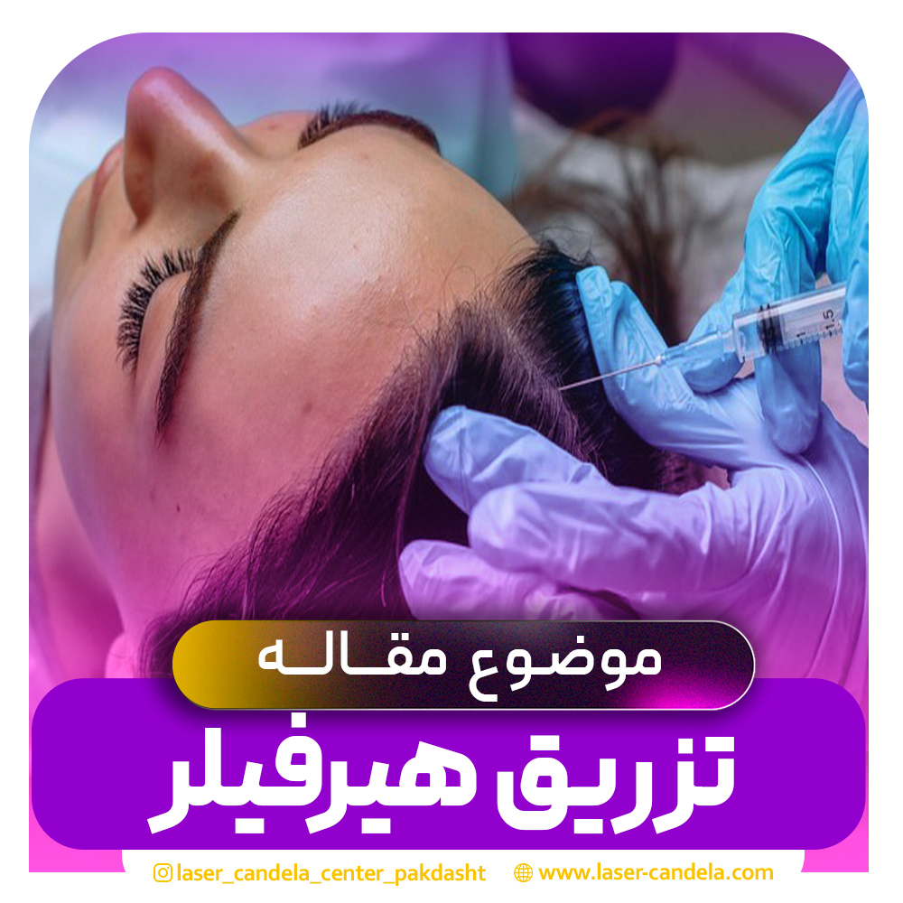 تزریق هیرفیلر چیست؟ و چگونه باعث درمان ریزش مو میشود